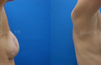 Breast Reconstruction Before and After | Sayah Institute