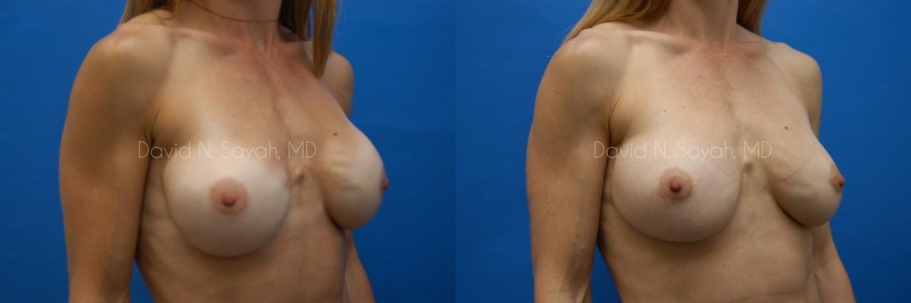 Breast Implant Revision Before and After | Sayah Institute