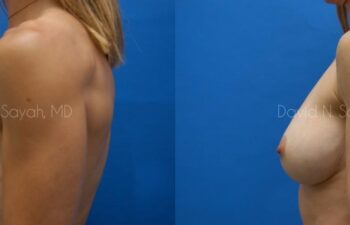 Breast Implant Revision Before and After | Sayah Institute