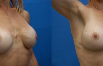 Breast Implant Revision Before and After | Sayah Institute