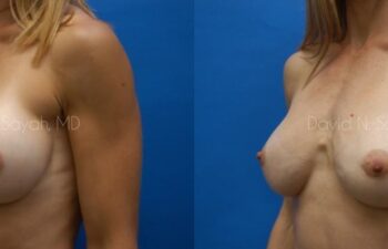 Breast Implant Revision Before and After | Sayah Institute