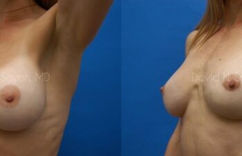 Breast Implant Revision Before and After | Sayah Institute