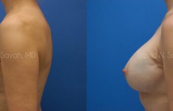 Breast Reconstruction Before and After | Sayah Institute
