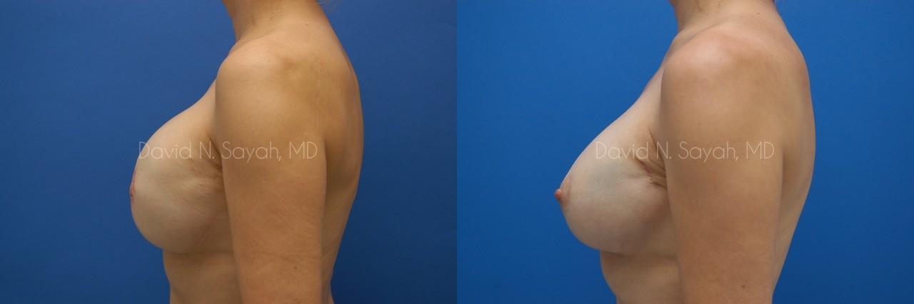 Breast Reconstruction Before and After | Sayah Institute