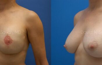 Breast Reconstruction Before and After | Sayah Institute