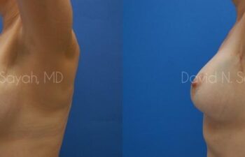 Breast Reconstruction Before and After | Sayah Institute