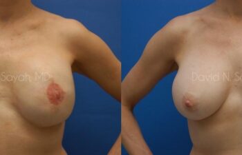 Breast Reconstruction Before and After | Sayah Institute