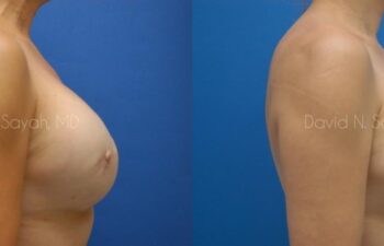 Breast Reconstruction Before and After | Sayah Institute