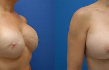 Breast Reconstruction Before and After | Sayah Institute