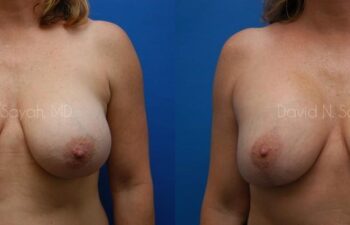 Breast Augmentation And Mastopexy Before and After | Sayah Institute