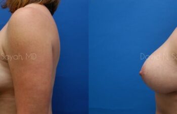 Breast Augmentation And Mastopexy Before and After | Sayah Institute