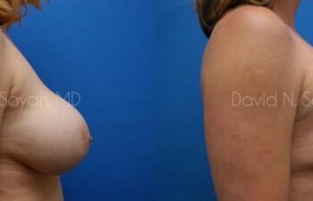 Breast Augmentation And Mastopexy Before and After | Sayah Institute