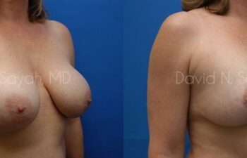 Breast Augmentation And Mastopexy Before and After | Sayah Institute