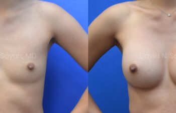 Side-by-side comparison of a person's chest before (left) and after (right) breast augmentation surgery against a blue background.