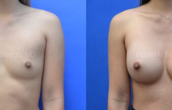 Side-by-side images showing a woman before and after breast augmentation surgery against a blue background.