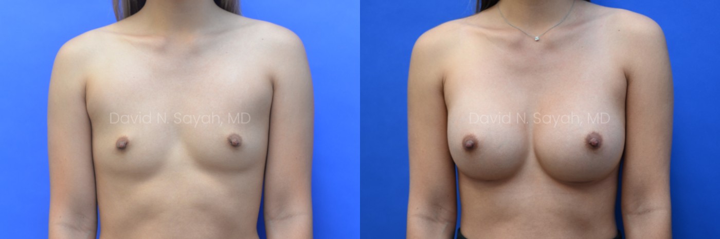 Side-by-side images showing a woman before and after breast augmentation surgery against a blue background.