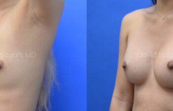Side-by-side comparison of a woman's chest before and after breast augmentation, showing increased breast size post-surgery against a blue background.