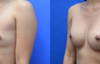 Side-by-side comparison of a woman's chest before and after breast augmentation surgery, against a blue background.