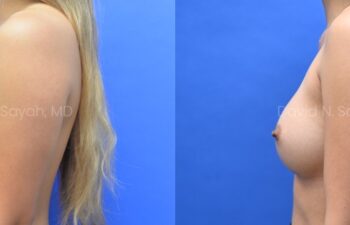 Side-by-side profile photos of a woman before and after breast augmentation surgery, showing an increase in breast size against a blue background.