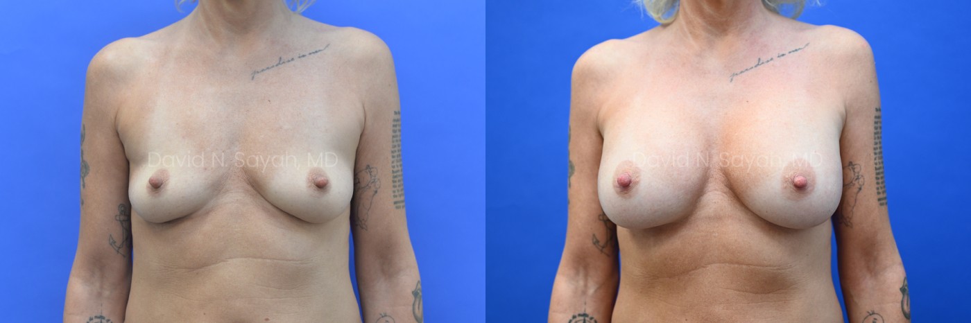 Side-by-side comparison of a woman's chest before (left) and after (right) breast augmentation, against a blue background.