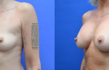 Side-by-side comparison of a woman's torso before (left) and after (right) breast augmentation against a blue background.