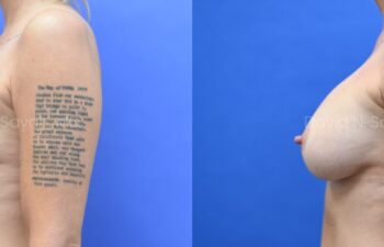 Side-by-side comparison of a woman's torso before and after breast augmentation, showing increased breast size against a blue background.