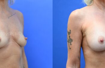 Side-by-side photos of a woman’s upper torso before and after breast augmentation, with visible tattoos on both arms, set against a blue background.