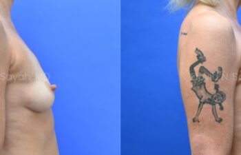 Side-by-side comparison of a woman's upper body before and after breast augmentation, showing increased breast size; she has a tattoo on her upper arm.