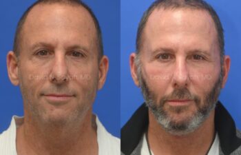 Side-by-side comparison of a man before and after hair restoration, with the left image showing less facial hair and the right image showing a fuller beard and hairline.