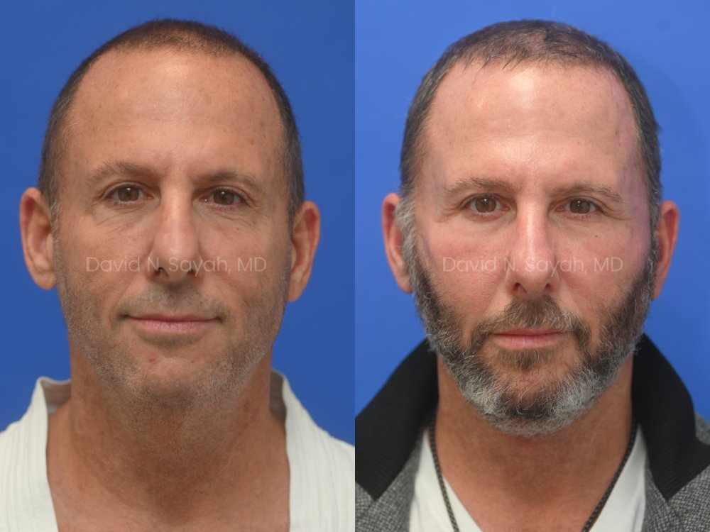 Side-by-side comparison of a man before and after hair restoration, with the left image showing less facial hair and the right image showing a fuller beard and hairline.
