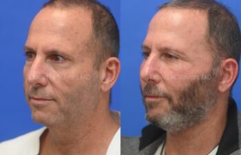 Side-by-side comparison of a man before and after beard transplant, showing increased facial hair and fuller beard on the right.