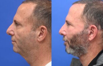Side-by-side profile photos of a man before and after a rhinoplasty and chin surgery, with changes to his nose shape and chin definition.