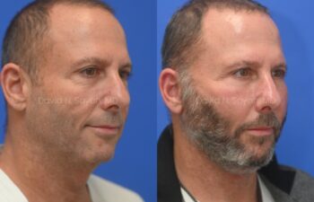 Side-by-side photos of a man before and after growing a beard, both taken against a blue background.