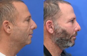 Side-by-side profile photos of a man before and after growing a beard, set against a blue background.