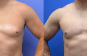 Side-by-side comparison of a male chest before and after gynecomastia surgery, with the left image showing excess breast tissue and the right image showing a flatter, more contoured chest.