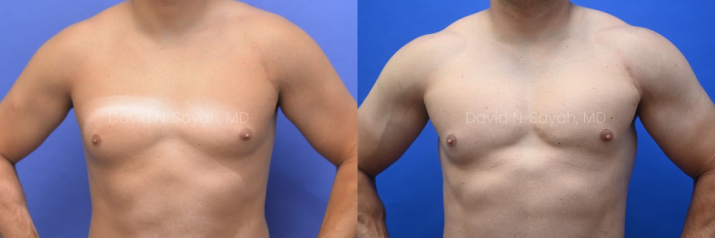 Side-by-side comparison of a male chest before and after gynecomastia surgery, with the left image showing excess breast tissue and the right image showing a flatter, more contoured chest.