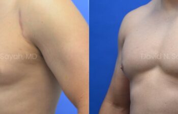 Side-by-side comparison of a male chest before and after gynecomastia surgery, with the left image showing excess breast tissue and the right image showing a flatter, more contoured chest.