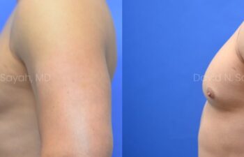 Side-by-side comparison of a male chest before and after gynecomastia surgery, with the left image showing excess breast tissue and the right image showing a flatter, more contoured chest.