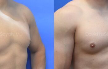 Side-by-side comparison of a male chest before and after gynecomastia surgery, with the left image showing excess breast tissue and the right image showing a flatter, more contoured chest.