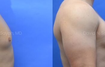 Side-by-side comparison of a male chest before and after gynecomastia surgery, with the left image showing excess breast tissue and the right image showing a flatter, more contoured chest.