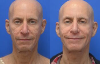Side-by-side photos of a bald man before and after a medical or cosmetic procedure, with slight differences in facial appearance and expression.