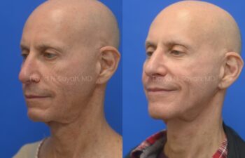 Side-by-side comparison of an older man before and after a cosmetic procedure, showing a reduction in nose size and improved skin texture.