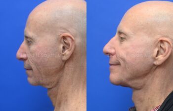 Side-by-side profile photos of a bald man before and after a cosmetic procedure, showing reduced sagging skin and a smoother jawline in the after image.