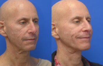 Side-by-side photos of a bald man before and after a medical or cosmetic procedure, showing differences in facial structure and skin texture against a blue background.