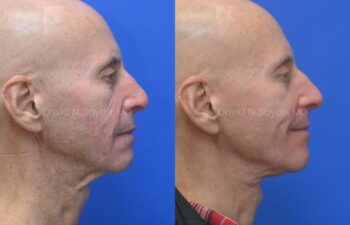 Side-by-side profile photos of a bald older man before and after a cosmetic procedure, showing smoother neck and jawline in the after image.