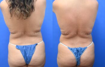 Liposuction of the abdomen and arms with fat transfer to the breasts | Sayah Institute