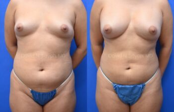 Liposuction of the abdomen and arms with fat transfer to the breasts | Sayah Institute
