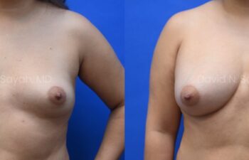 Liposuction of the abdomen and arms with fat transfer to the breasts | Sayah Institute