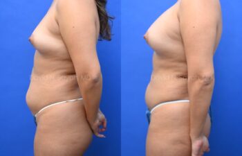 Liposuction of the abdomen and arms with fat transfer to the breasts | Sayah Institute