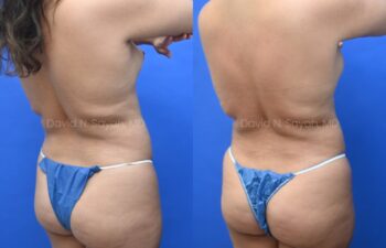 Liposuction of the abdomen and arms with fat transfer to the breasts | Sayah Institute